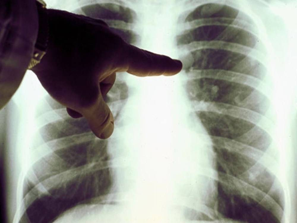 Рентген при туберкулезе. симптомы, признаки, описание рентгена при пневмонии :: polismed.com