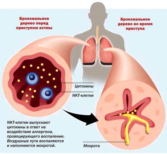 Атопическая бронхиальная астма: причины появления и профилактика