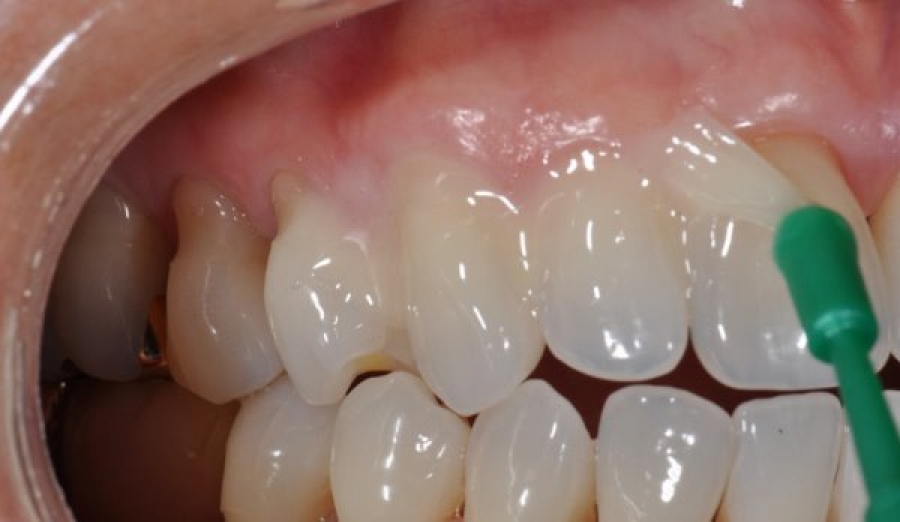 Как восстановить эмаль зубов:  стоматология и лечение зубов у беременных мам и детей