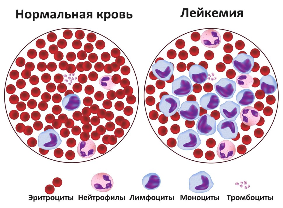 Лейкемия признаки по общему анализу крови