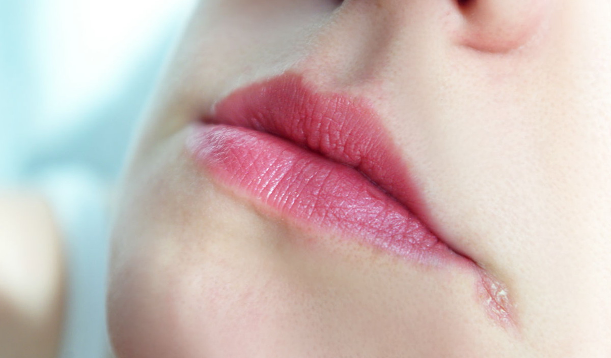 Из-за чего образовываются заеды в уголках рта и как их лечить