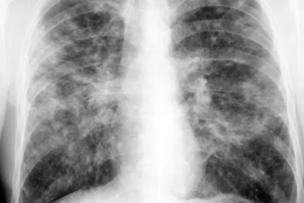 Туберкулез легких у взрослых: первые признаки, симптомы, лечение, причины появления. как лечить туберкулез