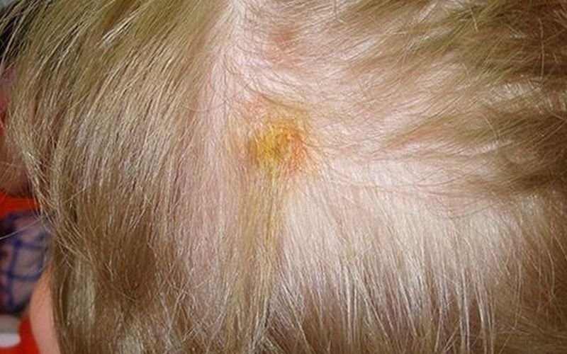 Грибок кожи головы: симптомы (фото) и лечение