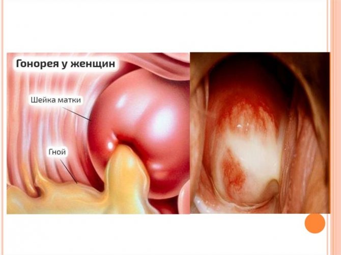 Бактериальный вагиноз - лечение и симптомы