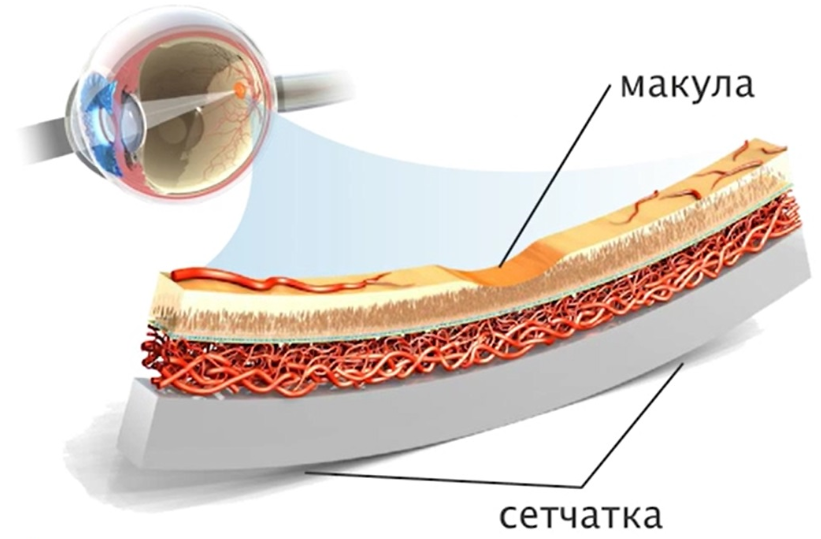 Что это такое макулодистрофия сетчатки глаза и лечение патологии