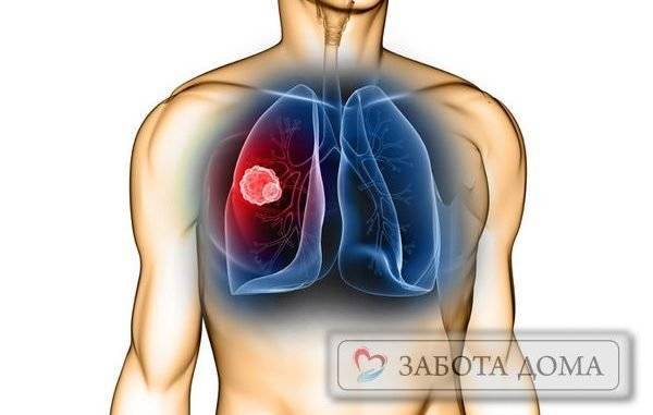 Пневмония у лежачих больных: причины, симптомы, лечение
