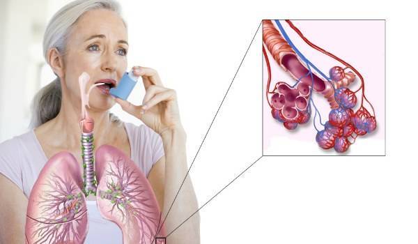 Одышка при бронхиальной астме: причины появления и профилактика