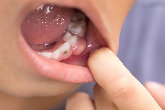 Удаление зуба с кистой на корне — показания, как происходит процедура, боль при удалении