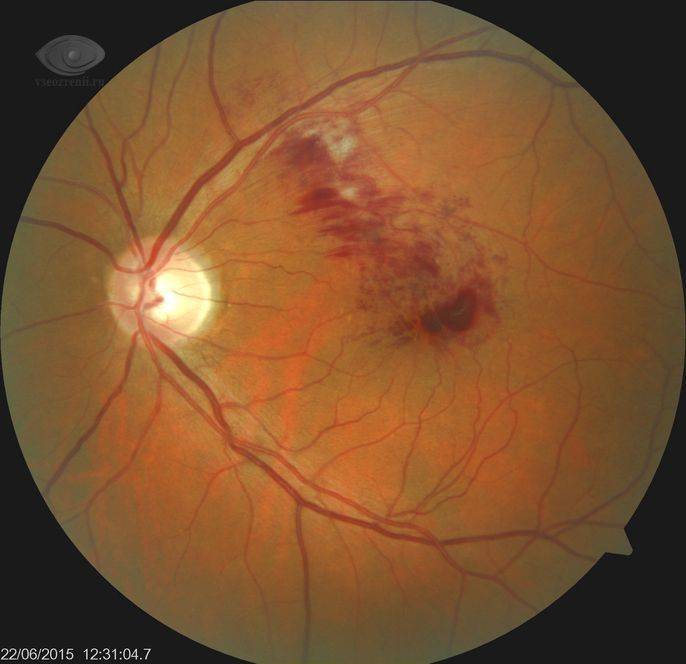 Тромбоз центральной вены сетчатки глаза: лечение, что это такое, цвс,