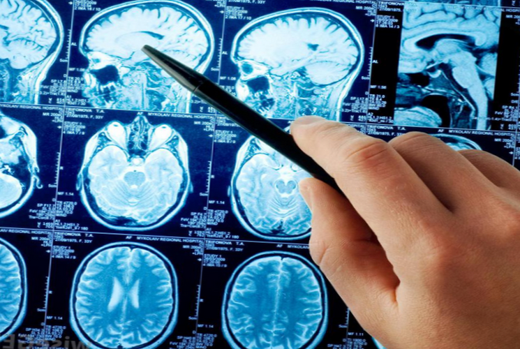 Инсульт головного мозга: симптомы, лечение и его последствия