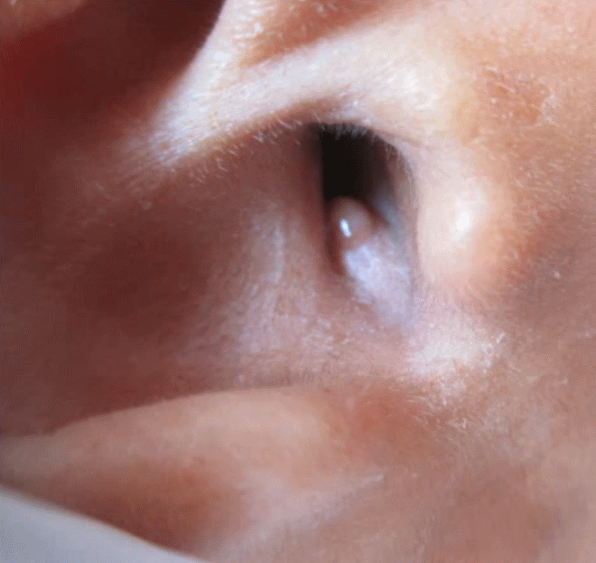 Прыщ в ухе – причины появления, профилактик и что поможет вылечить