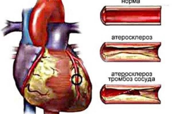 Атеросклеротический кардиосклероз: лечение, причины, профилактика
