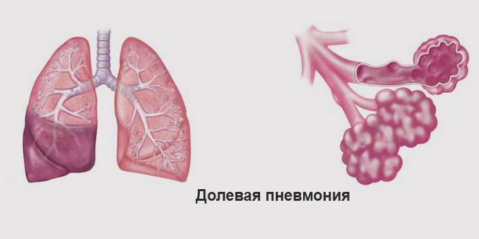 Карта вызова пневмония неуточненная