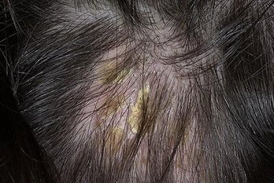Себорея кожи головы у детей лечение