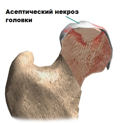 Остеохондропатия головки бедренной кости (болезнь легга - кальве - пертеса)