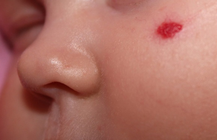 Как выглядит гемангиома у ребенка, ее причины возникновения и лечение
