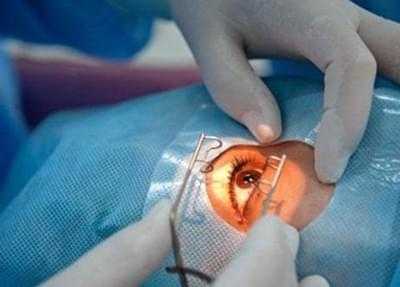Пингвекула - лечение наростов на глазах