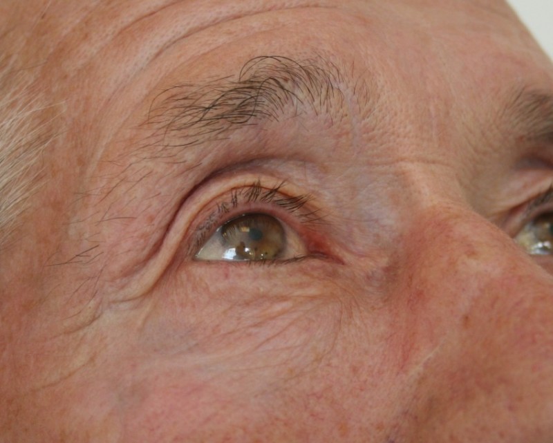 Закупорка сальных желез на лице, спине: лечение воспаления