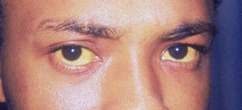 Пожелтевшие белки глаз при отравлении