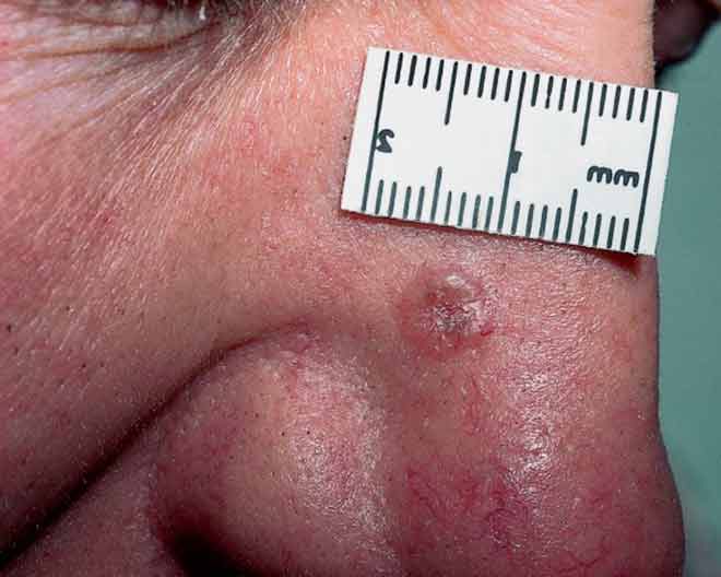 Базалиома на носу: признаки, лечение, облучение и фото
