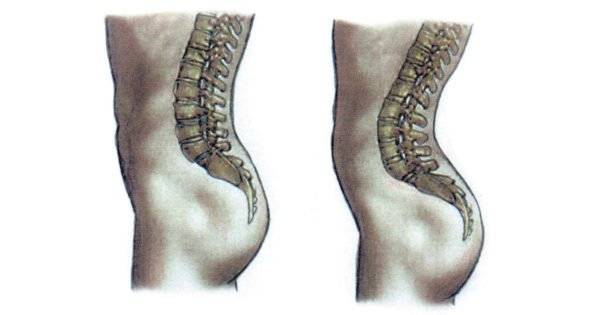 Умирают ли от искривления позвоночника?