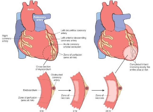Миокардит сердца: симптомы, лечение и классификация (ревматический и др.)