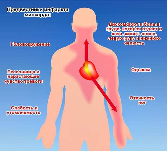 Типичные и атипичные признаки сердечного приступа у мужчин