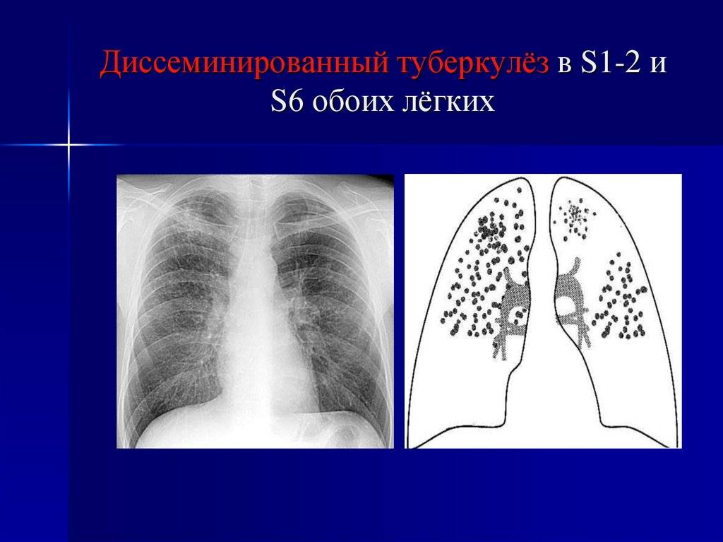 Диссеминированный туберкулез схема