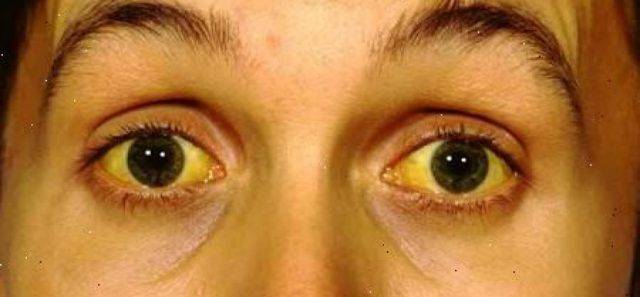 Причины и меры профилактики: почему белки глаз желтеют