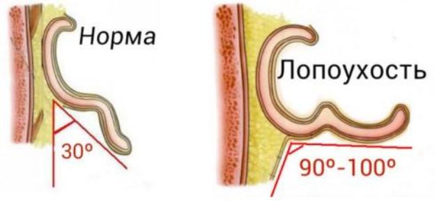 Степени лопоухости в картинках