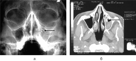 Лучевая картина при синуситах и кистах придаточных пазух носа