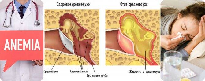 Основные причины и лечение свиста в ушах и голове