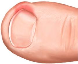 Удаление ногтя на большом пальце ноги при лечении