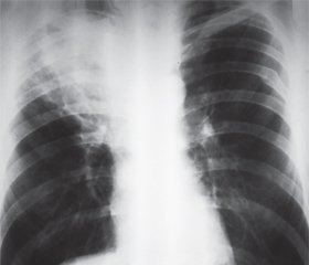Туберкулез и рак легких