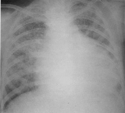 Пять отличий пневмонии и туберкулеза