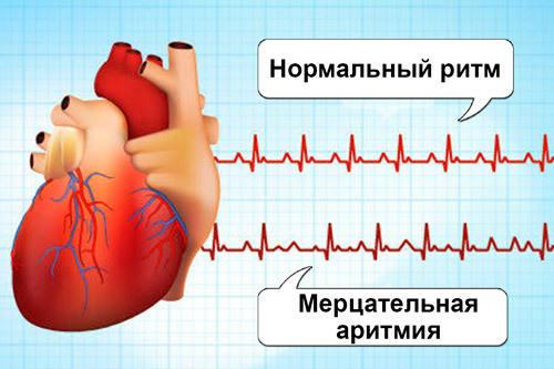 Сердечная аритмия