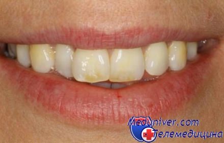 Почему возникает потемнение эмали зубов и как от этого избавиться?