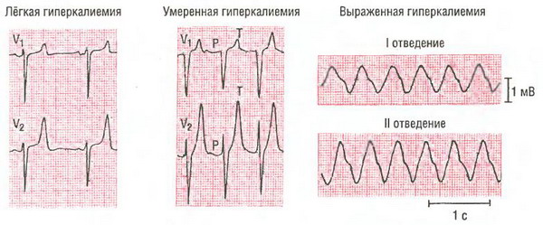 Ритмокор (rhythmocor)