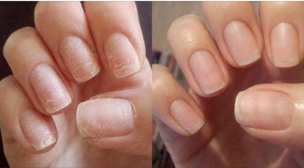 Как сделать ногти крепкими? что делать, если длинные ногти ломаются и расслаиваются? причины тонких, мягких и ломких ногтей на руках