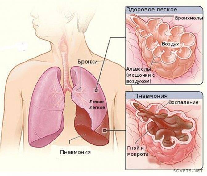 Какие симптомы помогут распознать пневмонию у лежачих больных и пожилых людей?