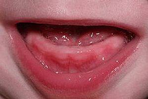 Прорезывание зубов у детей порядок и сроки - порядок прорезывания зубов - запись пользователя олеся (olesya21_86) в сообществе развитие от рождения до года в категории зубы - babyblog.ru