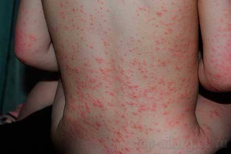 Диета при аллергии на коже у взрослых. меню, список продуктов