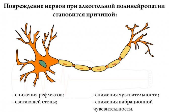 Периферическая нейропатия
