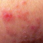 Что такое гепатомегалия: признаки и лечение заболевания