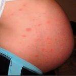Холестаз при беременности: симптомы и лечение застоя желчи