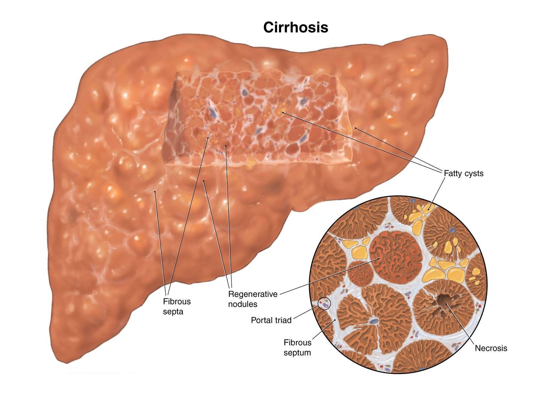 Поджелудочная железа фиброзные изменения. Фиброзный цирроз печени. Гепатитный цирроз печени.