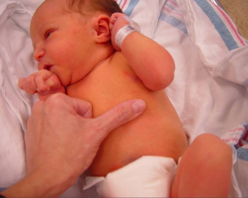 Увеличена печень у новорожденного. Желтушка у новорожденных. Желтушность кожи у новорожденного. Что такое желтушка у новорожденных детей. Желтушка у новорожденных фото.
