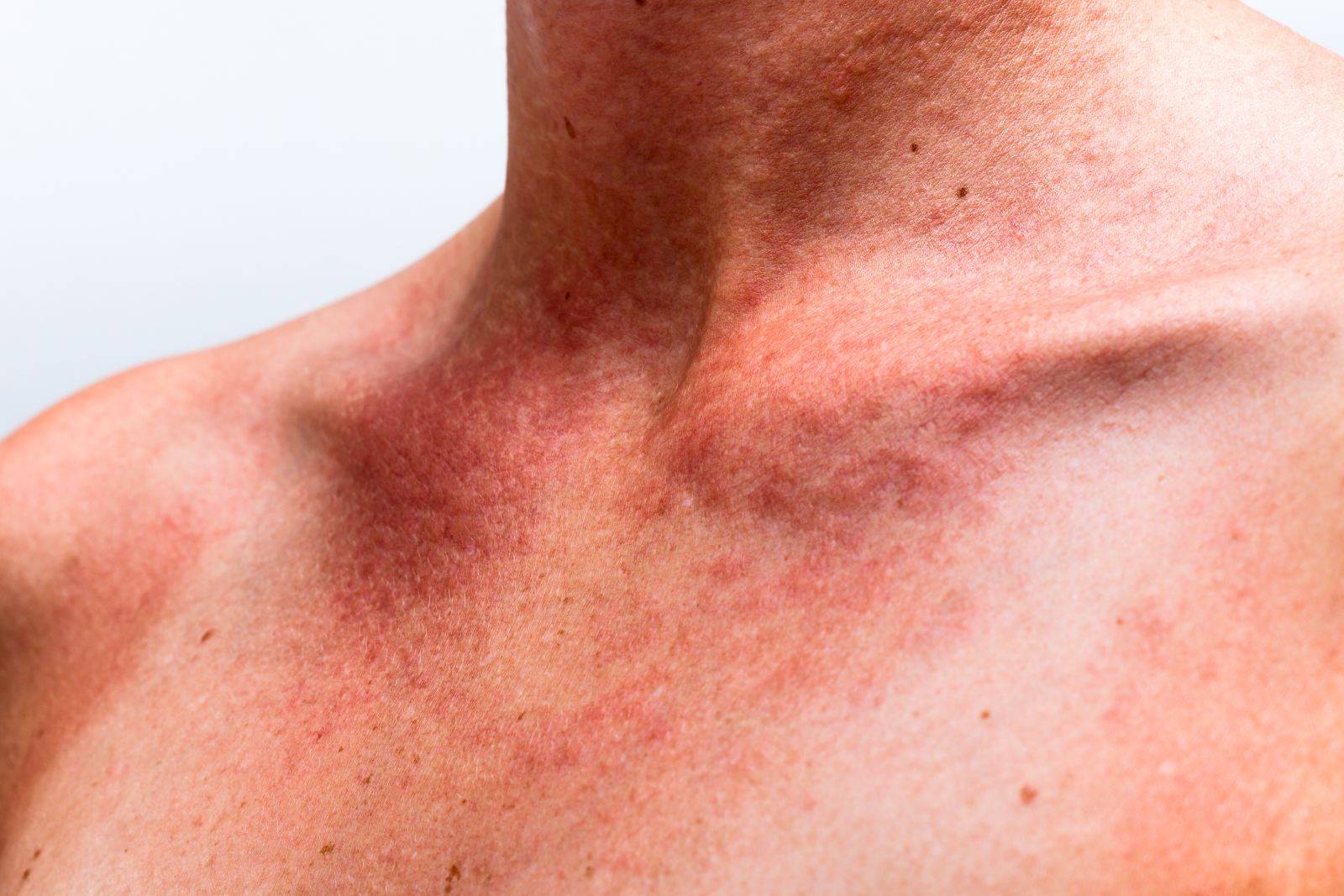 Аллергия при болезни печени и желчного пузыря thumbnail