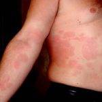 Может ли быть аллергия при заболевании печени?