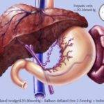 Что такое портальный цирроз печени: симптомы и лечение